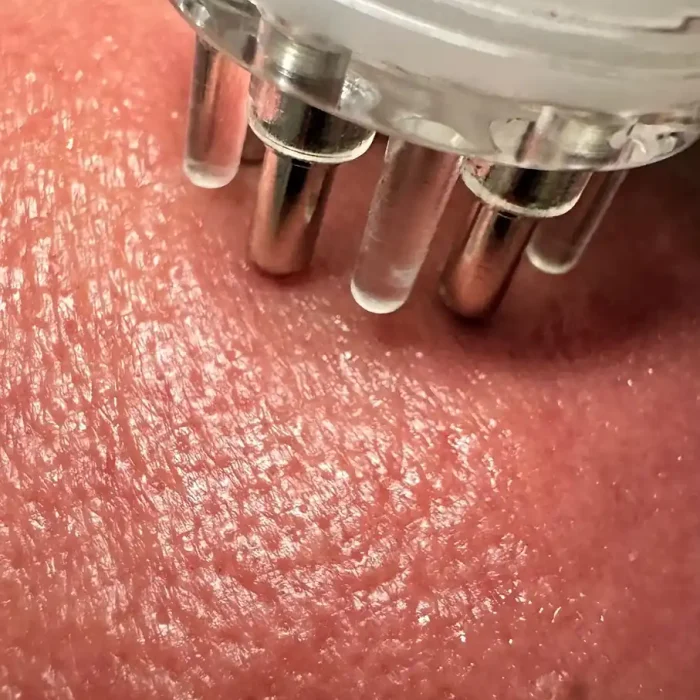 fabi-maciel-estetica-infusion-colageno-13
