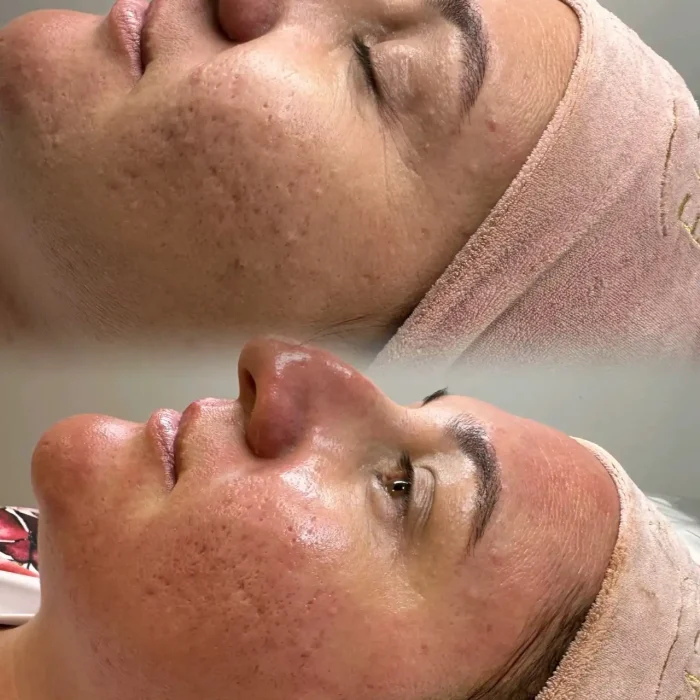 fabi-maciel-estetica-infusion-colageno-5