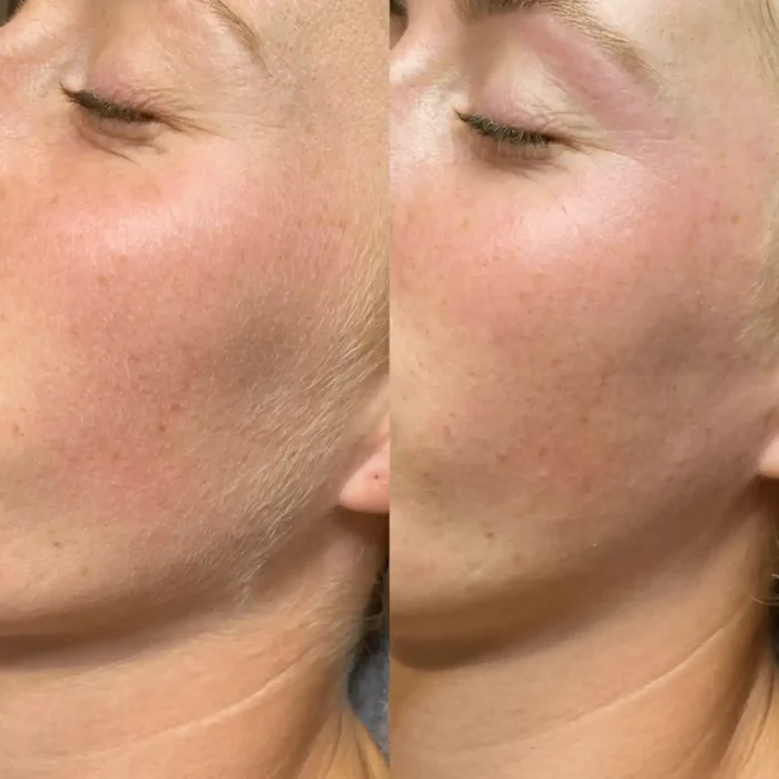 fabi-maciel-estetica-procedimento-dermaplaning-sensory-10