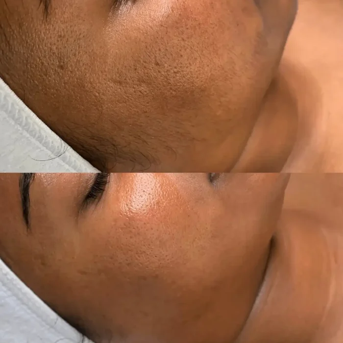 fabi-maciel-estetica-procedimento-dermaplaning-sensory-3