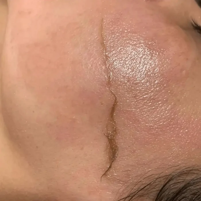 fabi-maciel-estetica-procedimento-dermaplaning-sensory-4