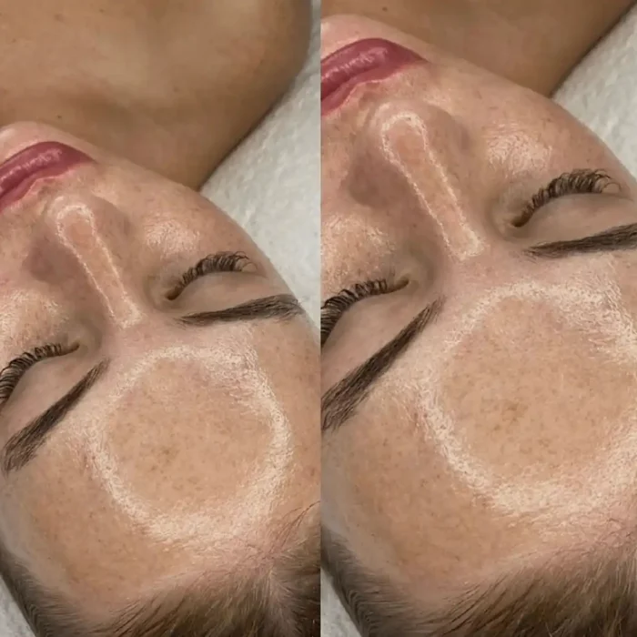 fabi-maciel-estetica-procedimento-dermaplaning-sensory-5