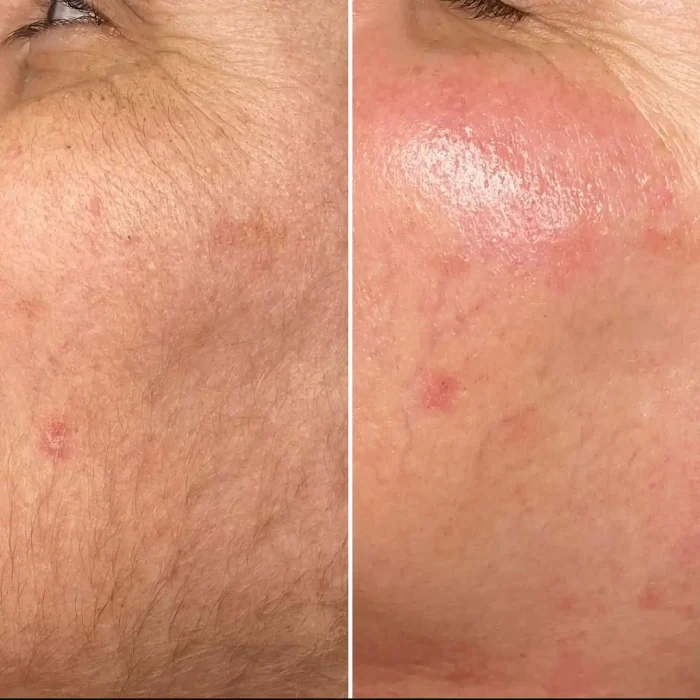 fabi-maciel-estetica-procedimento-dermaplaning-sensory-6