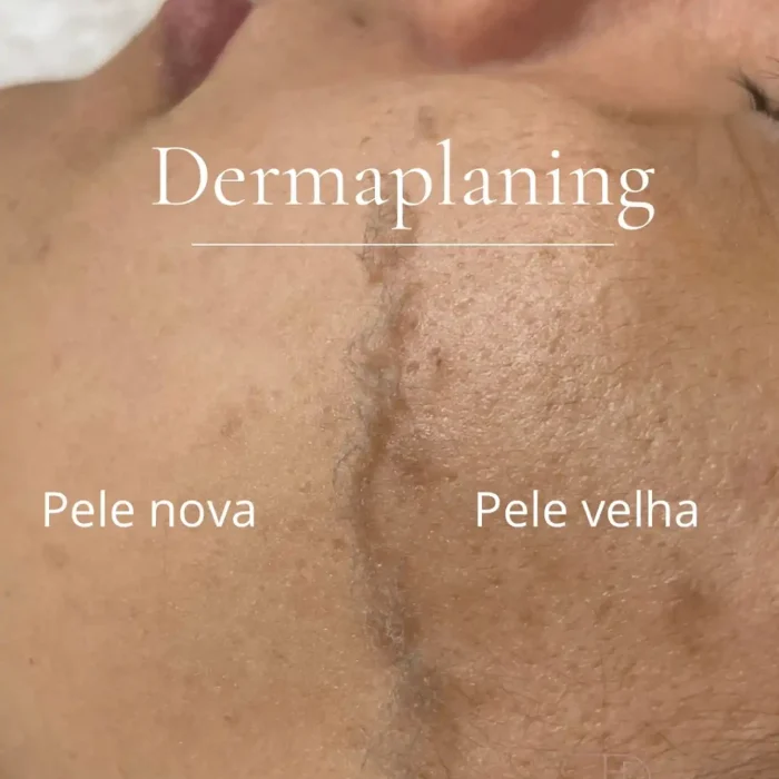 fabi-maciel-estetica-procedimento-dermaplaning-sensory-9