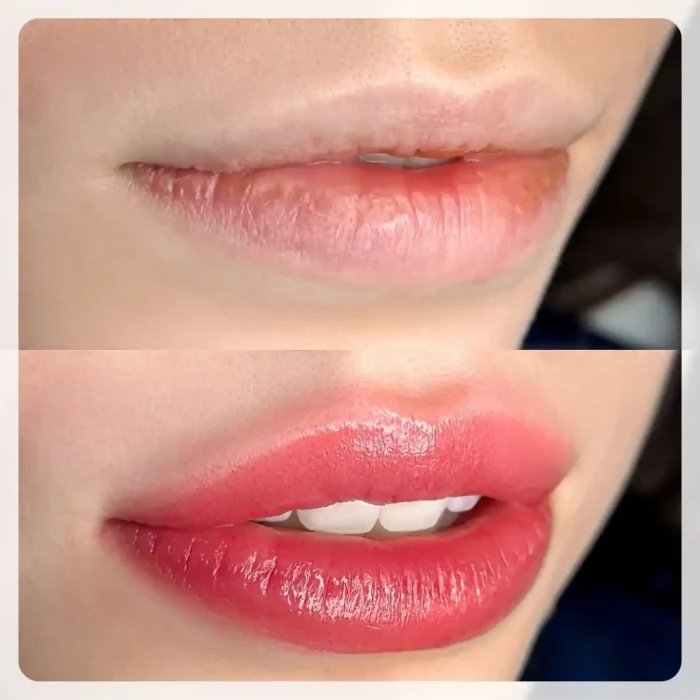 fabi-maciel-estetica-procedimento-flow-lips-galeria-1