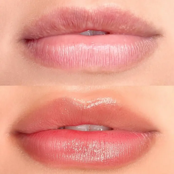 fabi-maciel-estetica-procedimento-flow-lips-galeria-2