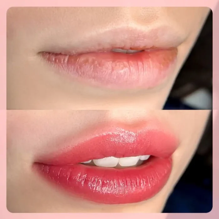 fabi-maciel-estetica-procedimento-flow-lips-galeria-3