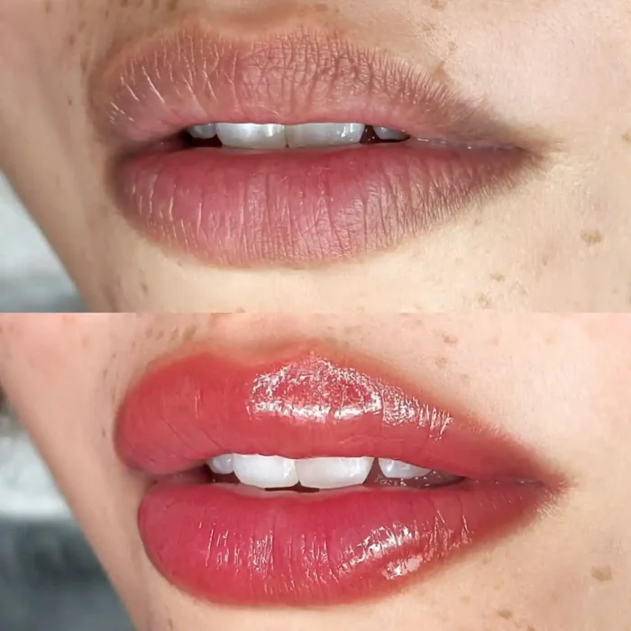 fabi-maciel-estetica-procedimento-flow-lips-galeria-5