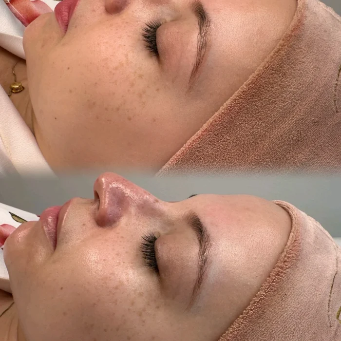 fabi-maciel-estetica-procedimento-limpeza-coreana-de-pele-indolor-1