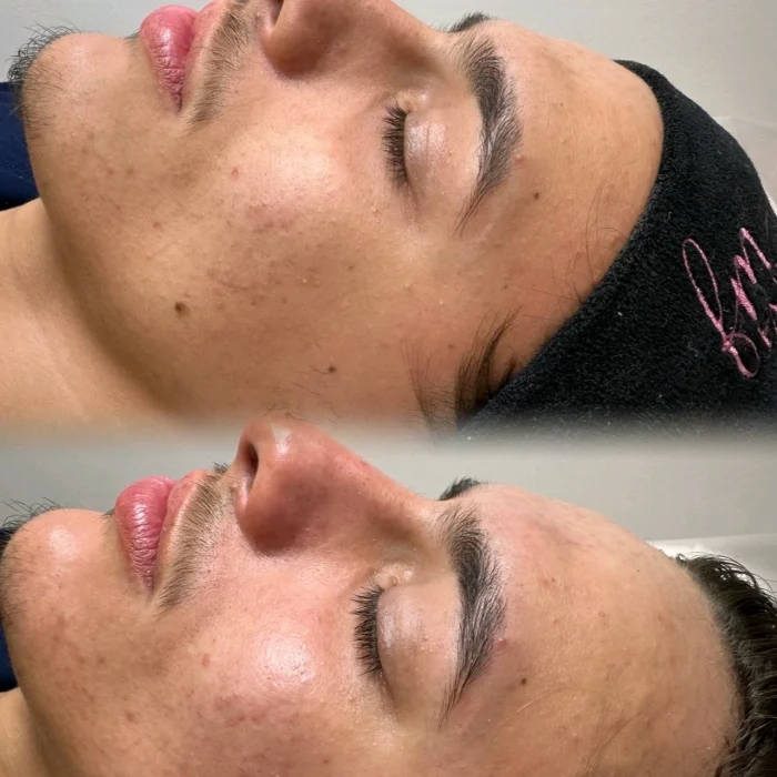 fabi-maciel-estetica-procedimento-limpeza-coreana-de-pele-indolor-3