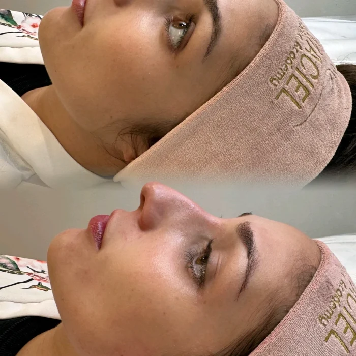 fabi-maciel-estetica-procedimento-limpeza-coreana-de-pele-indolor-5