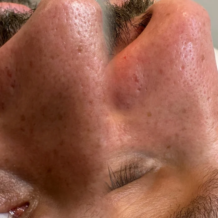 fabi-maciel-estetica-procedimento-limpeza-coreana-de-pele-indolor-6