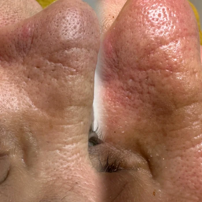 fabi-maciel-estetica-procedimento-limpeza-coreana-de-pele-indolor-8