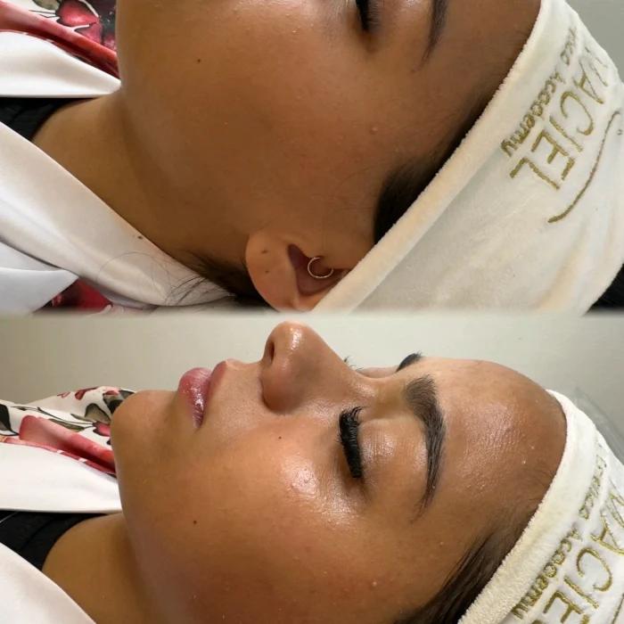 fabi-maciel-estetica-procedimento-limpeza-coreana-de-pele-indolor-9