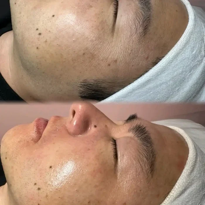 fabi-maciel-estetica-procedimento-peeling-sal-marinho-galeria-1