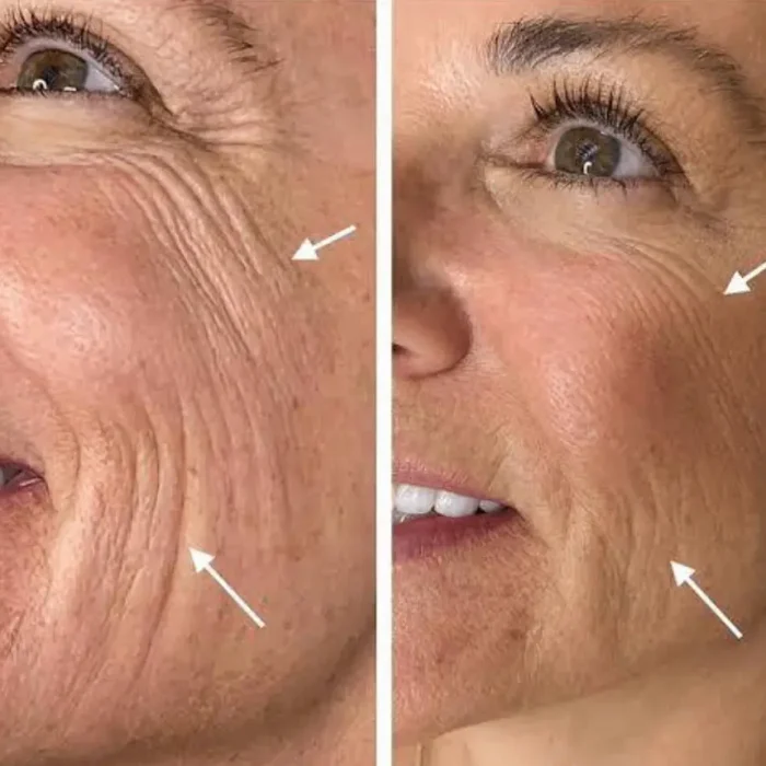 fabi-maciel-estetica-procedimento-peeling-sal-marinho-galeria-7