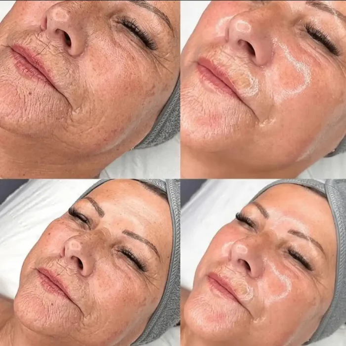fabi-maciel-estetica-procedimento-peeling-sal-marinho-galeria-9