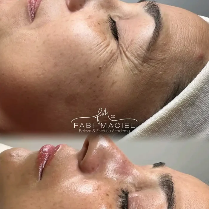 fabi-maciel-estetica-procedimento-peeling-vegano-1