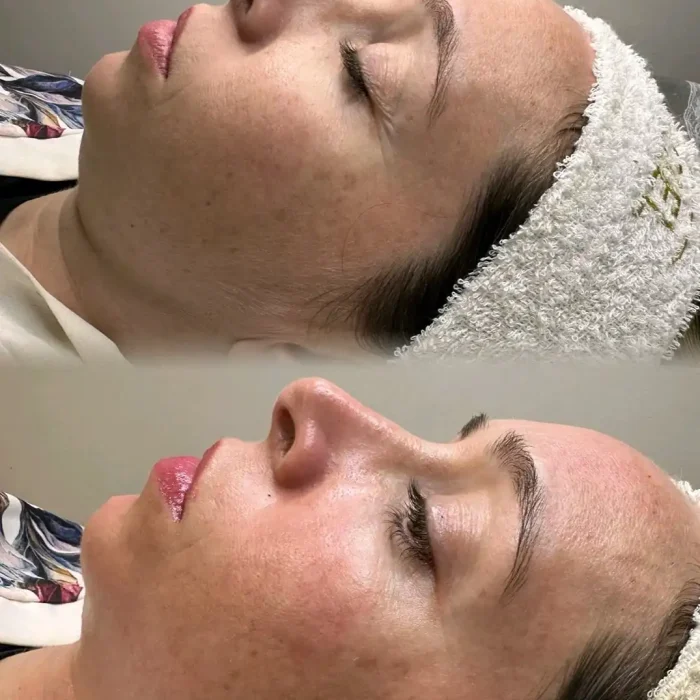fabi-maciel-estetica-procedimento-peeling-vegano-2