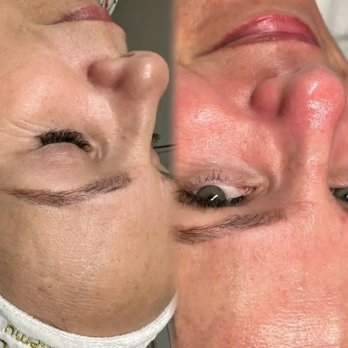 fabi-maciel-estetica-procedimento-peeling-vegano-3
